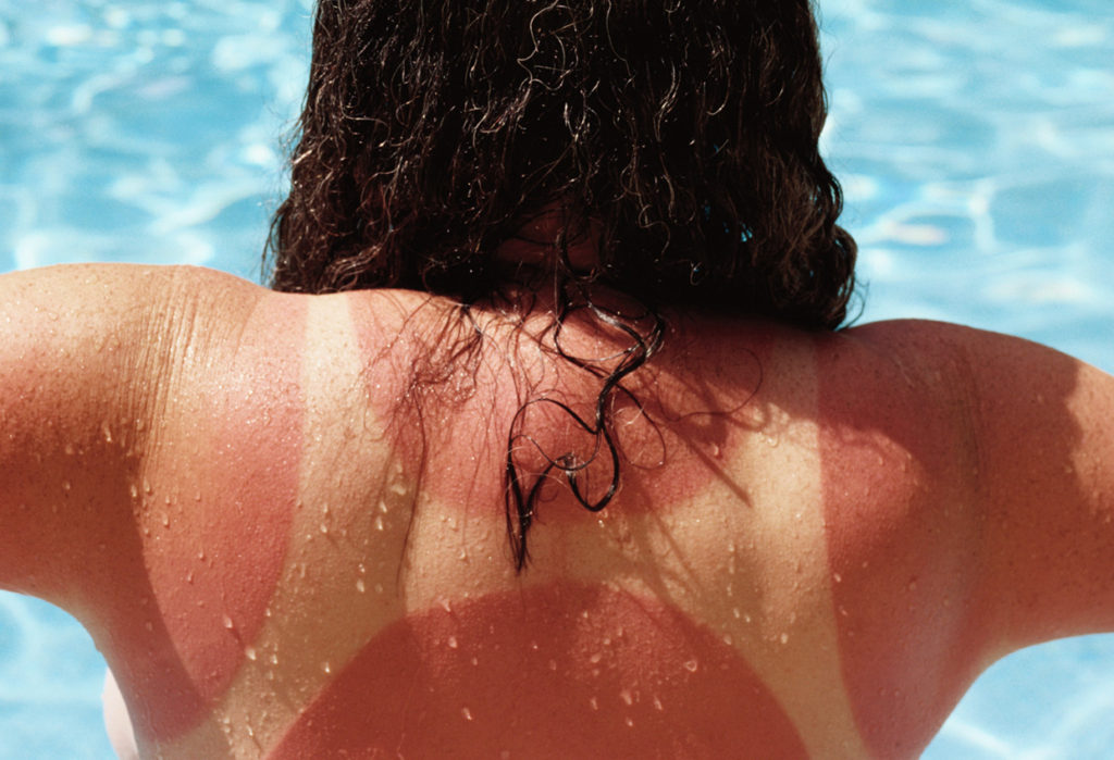 Woman with Sunburnt Back