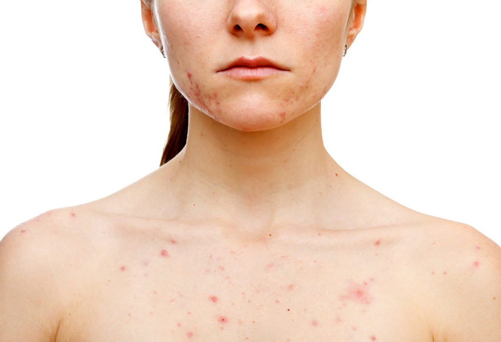 5 Mitos sobre el acné